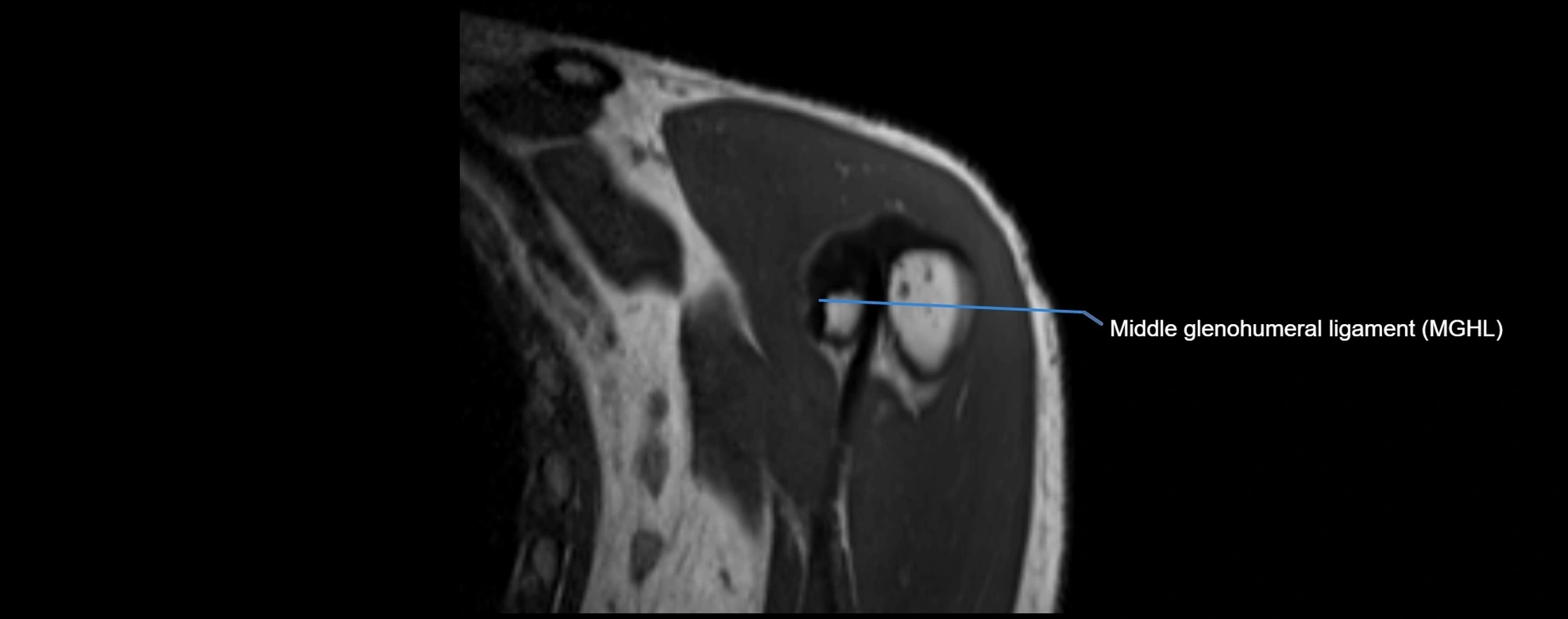 shoulder ligments coronal  cross sectional anatomy 3T MRI AI enhanced radiology image -img-00001-00005.webp